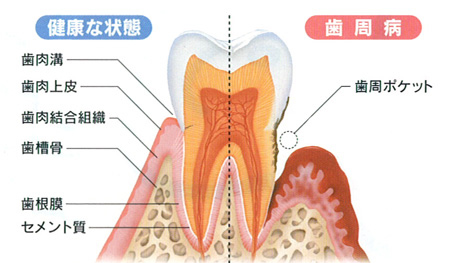 ひかりのテラス歯科クリニックプラス_歯周病治療